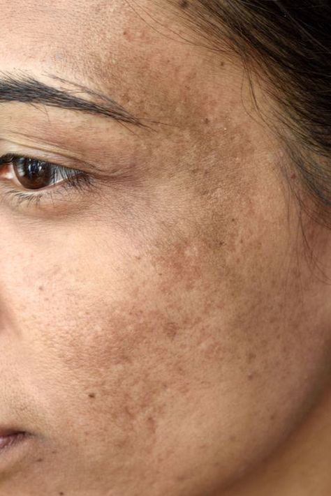 melasma