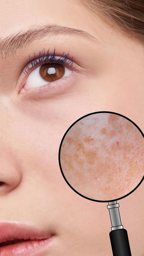 melasma