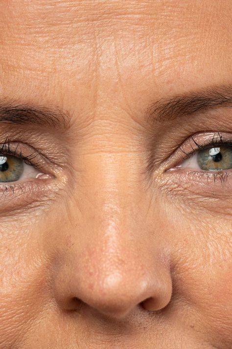 Squintmaxxing Wrinkles: The Impact of Squinting on Your Skin