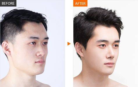 Sunken cheeks in men