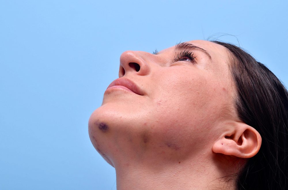 Swelling or bruising at the injection site in the jaw area