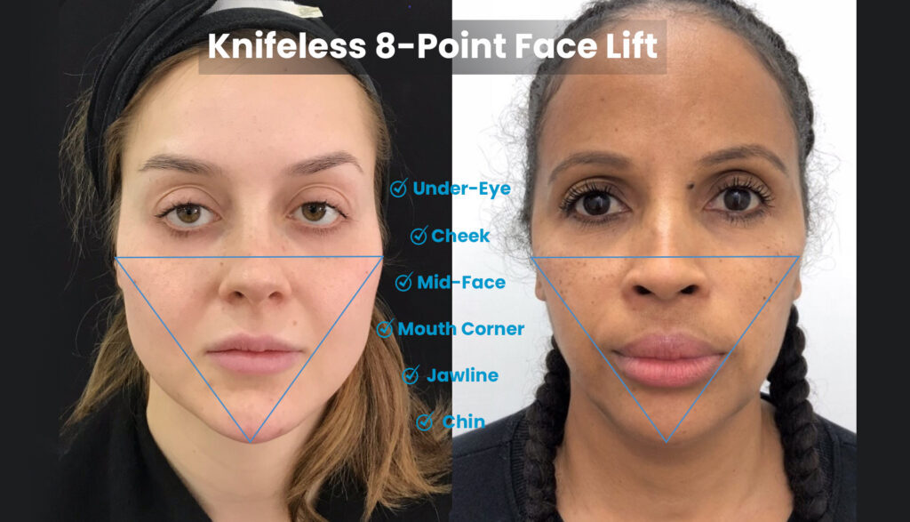 The 8 Point Filler Facelift Procedure