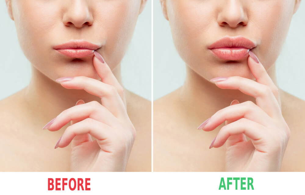 The Benefits of Good Lip Fillers