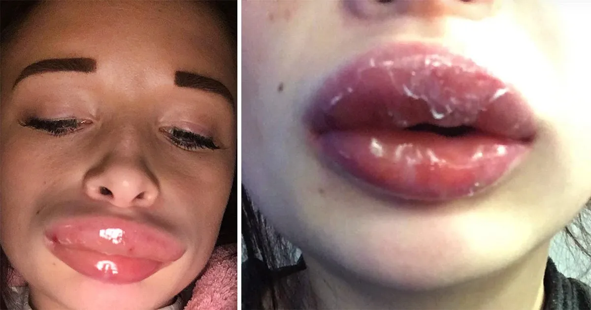 What Causes Lips Peeling After Filler?