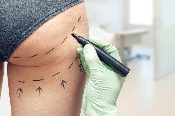 What is a Hip and Bum Filler Course?