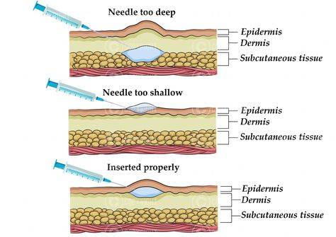 what is mesotherapy