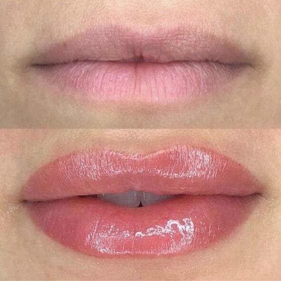 what to avoid before lip fillers