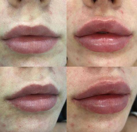 what to avoid before lip fillers