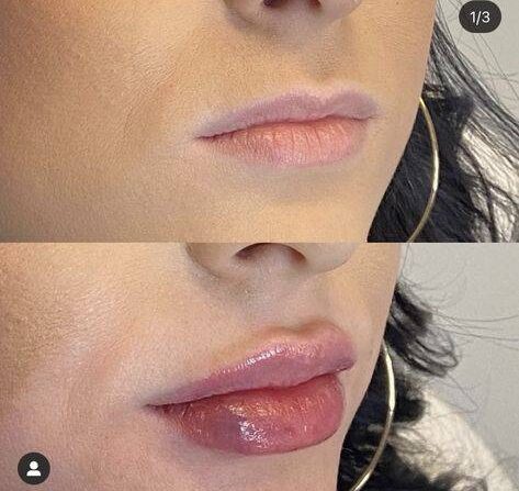 why do women get lip fillers