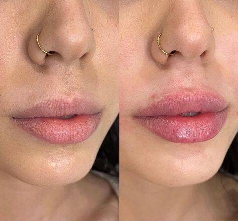 why do women get lip fillers