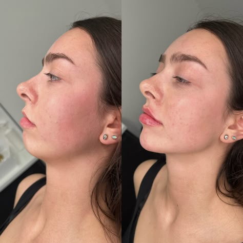 1 ml filler before and after