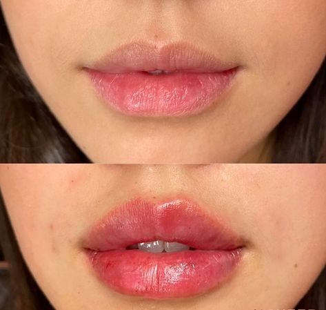 1 ml filler before and after