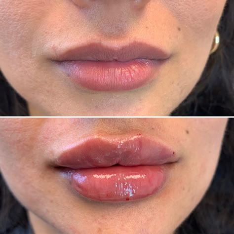 1 ml vs 2 ml lip filler