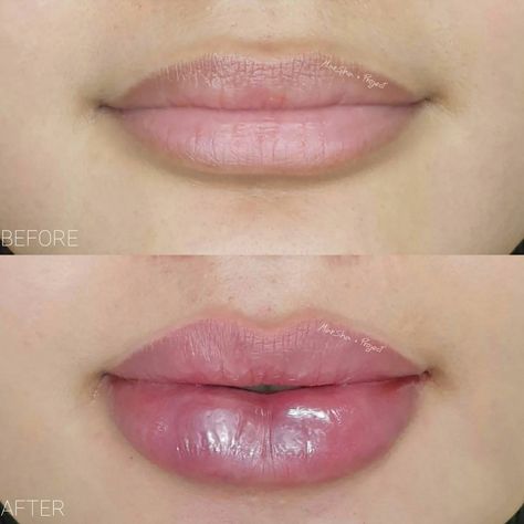 1 ml vs 2 ml lip filler