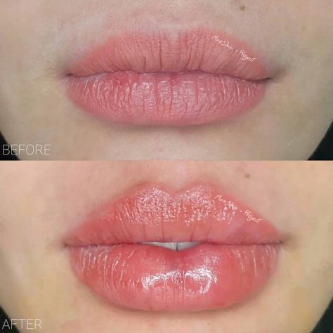 1 ml vs 2 ml lip filler