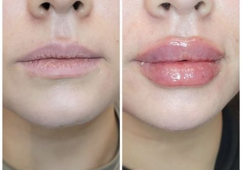 1 ml vs 2 ml lip filler