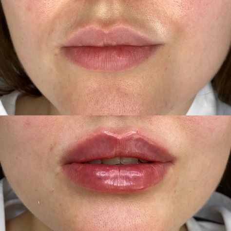 1 ml vs 2 ml lip filler