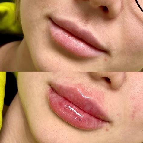 1 ml vs 2 ml lip filler