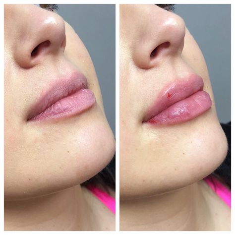 1 ml vs 2 ml lip filler