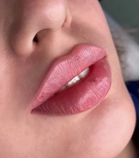 1 ml vs 2 ml lip filler