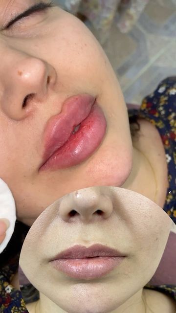 1 ml vs 2 ml lip filler