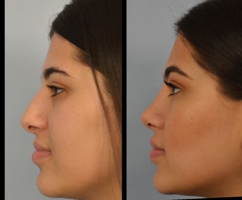 1ml chin filler before and after