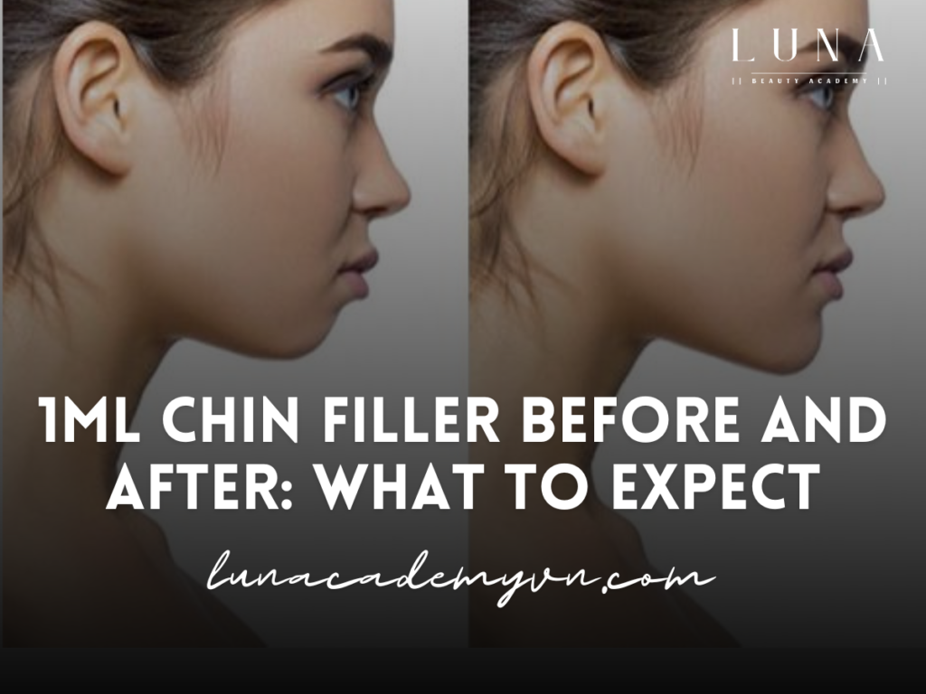 1ml chin filler before and after