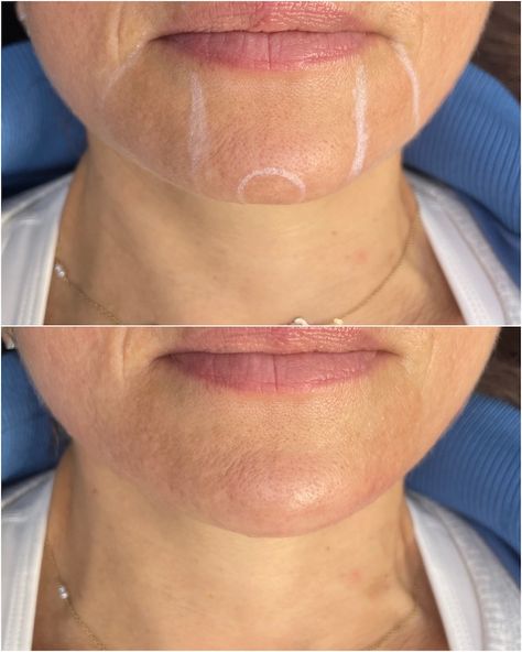 1ml chin filler before and after