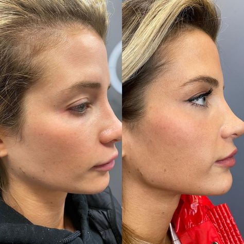 1ml chin filler before and after