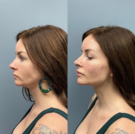 1ml chin filler before and after