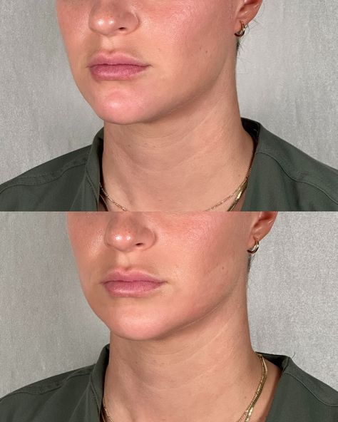 1ml chin filler before and after