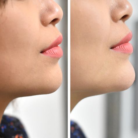 1ml chin filler before and after