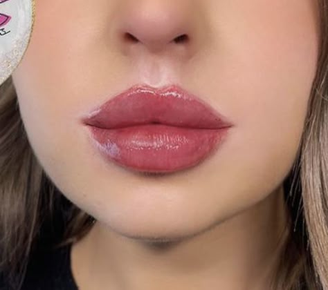 1ml vs 2ml Lip Filler: The Right Volume for Your Lips