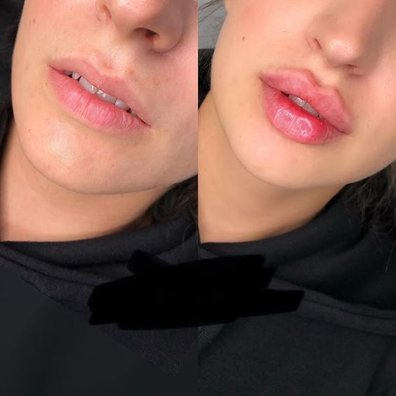 1ml vs 2ml Lip Filler: The Right Volume for Your Lips