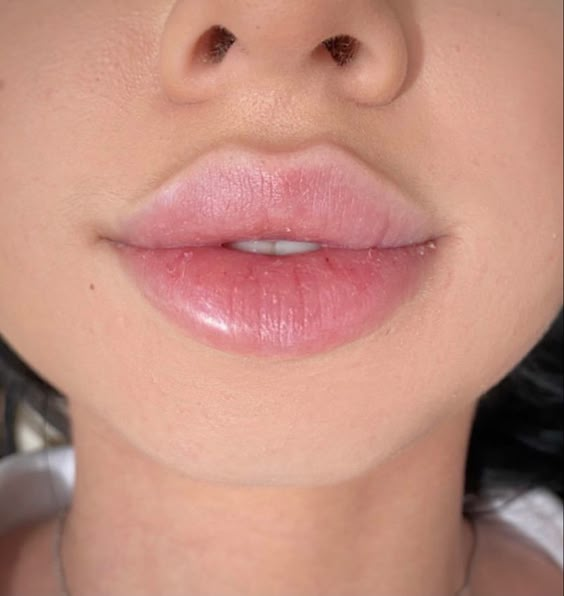 1ml vs 2ml Lip Filler: The Right Volume for Your Lips