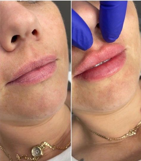 1ml vs 2ml Lip Filler: The Right Volume for Your Lips