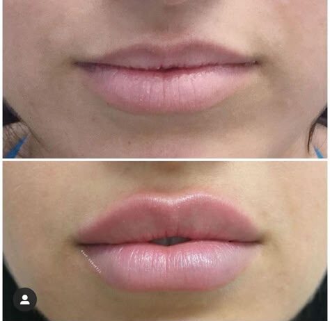 1ml vs 2ml Lip Filler: The Right Volume for Your Lips