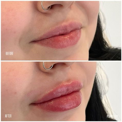 1ml vs 2ml Lip Filler: The Right Volume for Your Lips