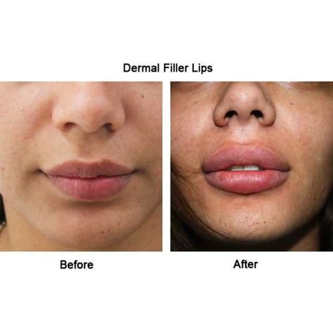 1ml vs 2ml Lip Filler: The Right Volume for Your Lips