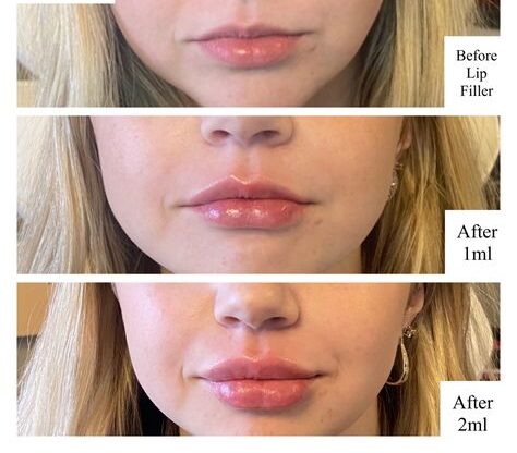 1ml vs 2ml Lip Filler: The Right Volume for Your Lips