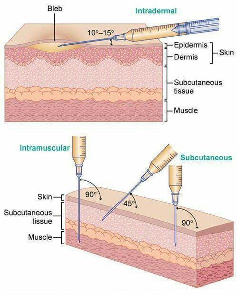 25 Gauge Needle Size: An Essential Guide