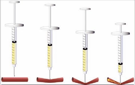 25 Gauge Needle Size: An Essential Guide