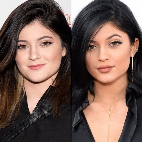 Celebs with Lip Fillers