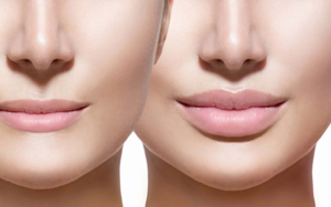 Maintenance and Longevity of Results of Lip Filler