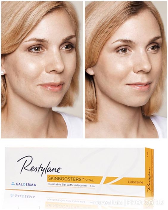 Restylane