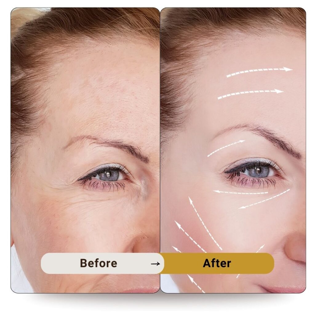 Allergan Botox result