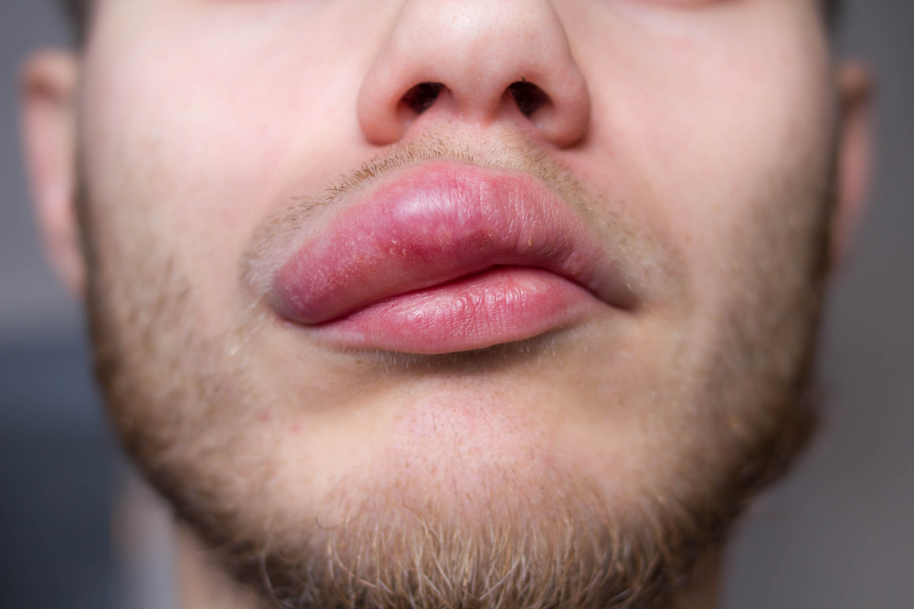 Allergic Reactions for lips