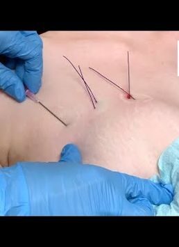 Aptos Threading Breast: Non-Surgical Lift for Natural Results