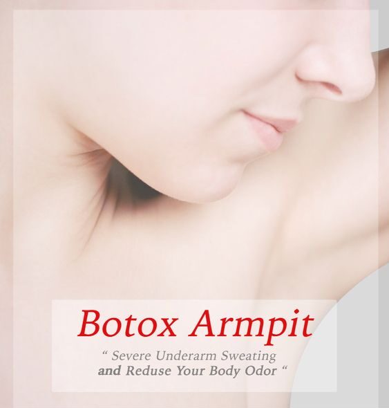 Armpit Botox result 