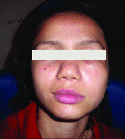 Asymmetry cheek in Swelling